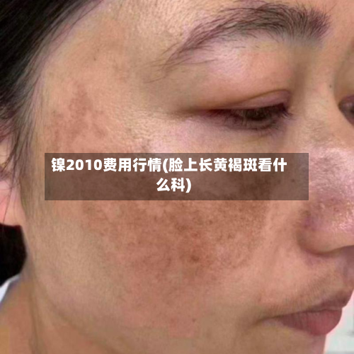 镍2010费用行情(脸上长黄褐斑看什么科)-第2张图片